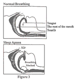 Sleeping Disorders